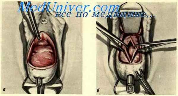 Влагалищное кесарево сечение.
