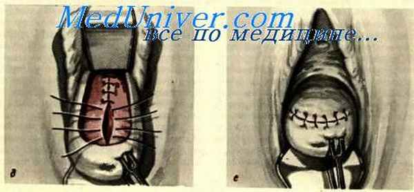 Влагалищное кесарево сечение.