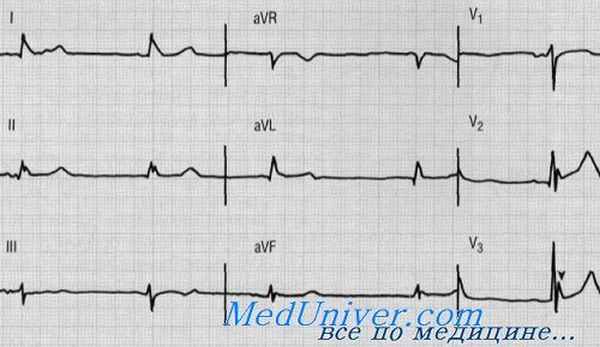 экг при гиперкалиемии