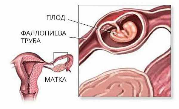 внематочная беременность.jpg