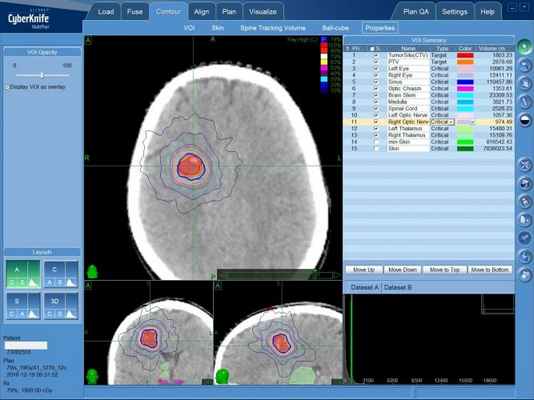 Артериовенозные мальформации (АВМ): план лечения на КиберНоже