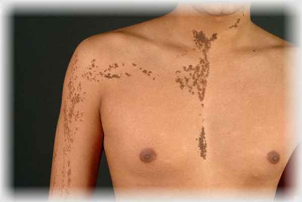 невус на груди