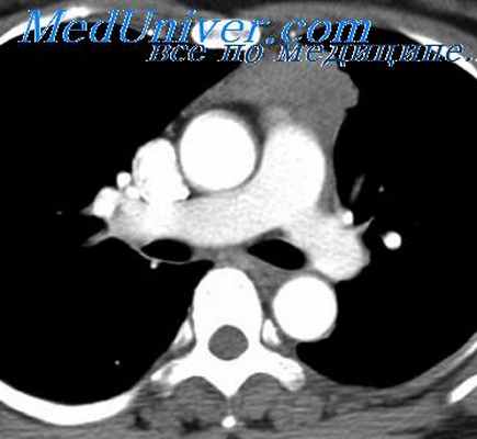 эхинококк средостения