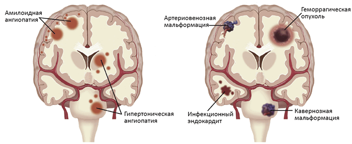 Причины внутримозгового кровоизлияния