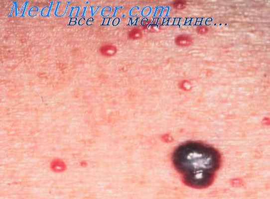 геммангиома