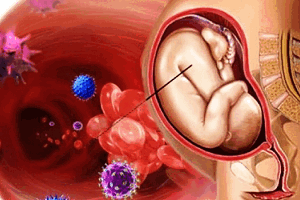 Внутриутробные инфекции
