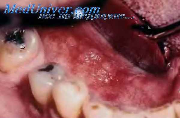 эритроплакия