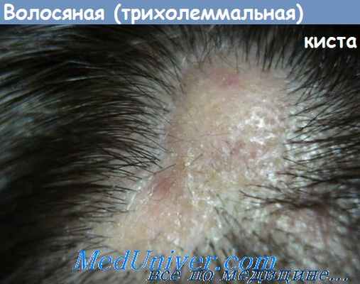трихолеммальная киста