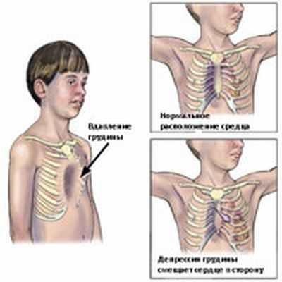 Деформации грудной клетки