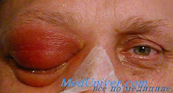 воспаление орбиты