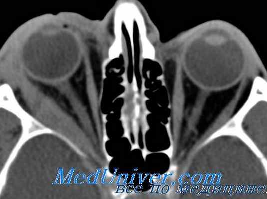 субпериостальный абсцесс