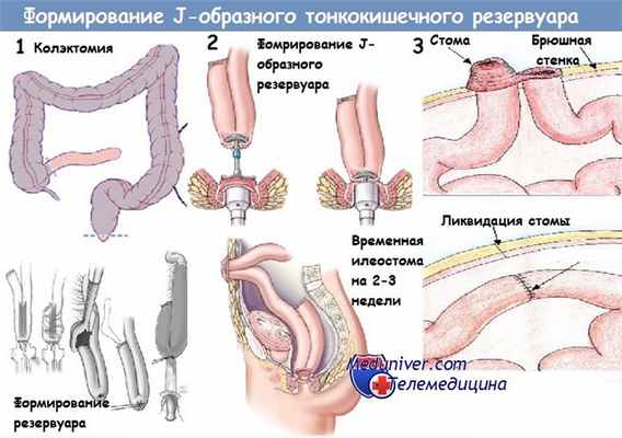 Формирование J-образного тонкокишечного резервуара