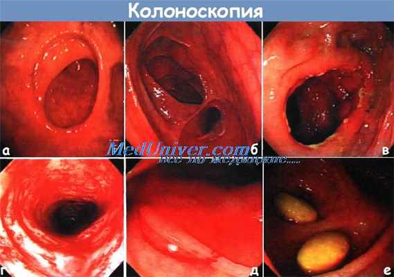 Колоноскопия