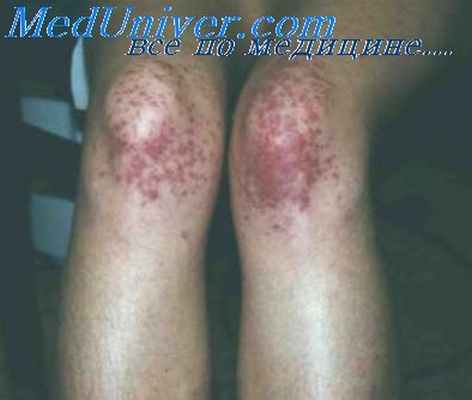 пигментная пурпура