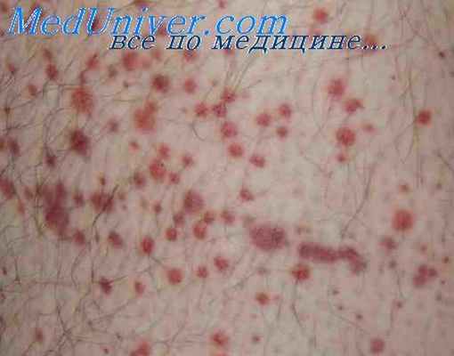 панникулит узловатый