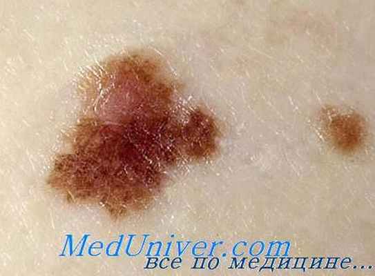 эпидермальный невус