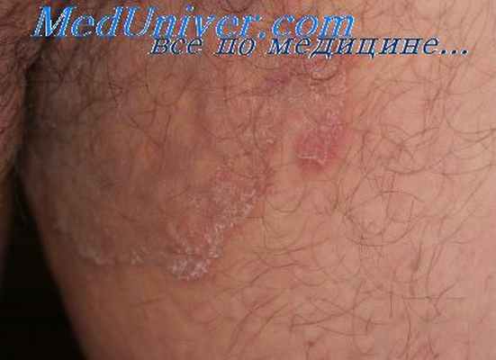 дерматомикозы