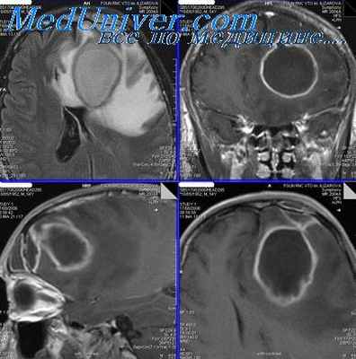 отогенный лептоменингит