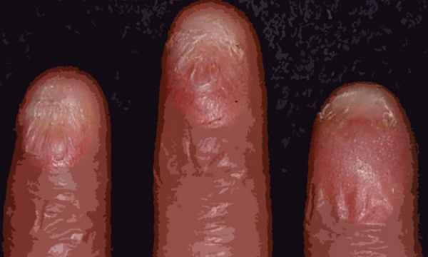 Анонихия (отсутствует ноготь): виды, причины, возможности лечениям