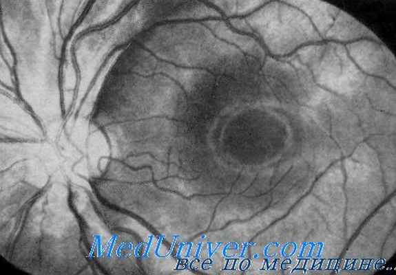 атрофия зрительного нерва