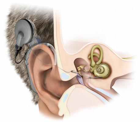Лечение сенсоневральной тугоухости