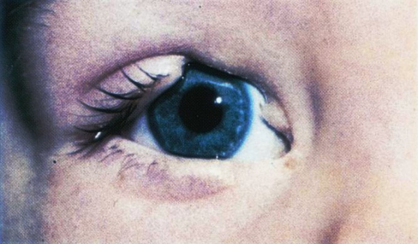 Аномалия развития глаза