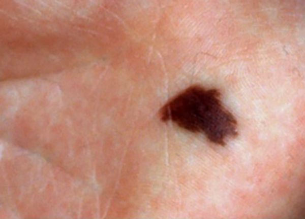 Врождённый меланоцитарный невус на ладони