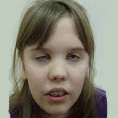 Врожденная миопатия