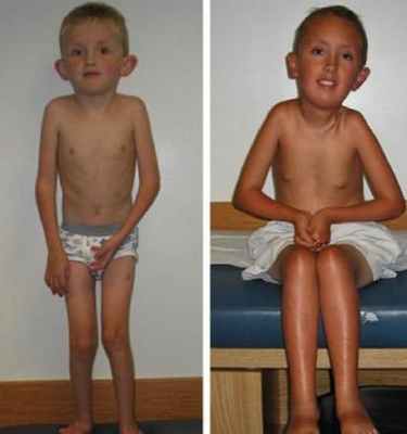 врожденные мышечные дистрофии