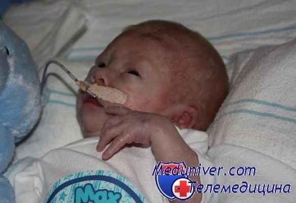 нефротический синдром у детей