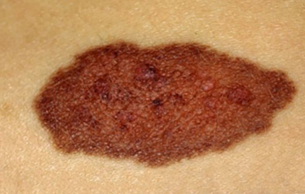 Невус средних размеров