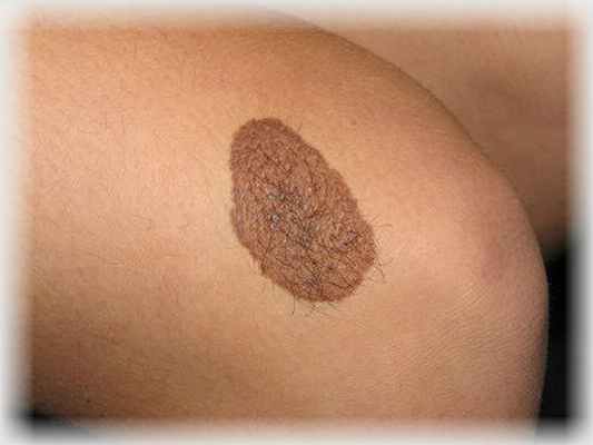 Размер невусов в зависимости от возраста