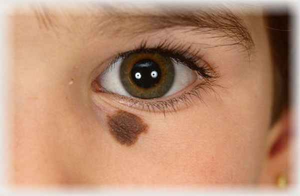 Особенности невусов