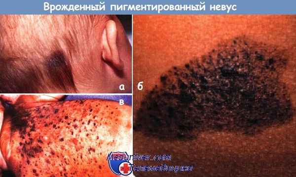 Врожденный пигментированный невус