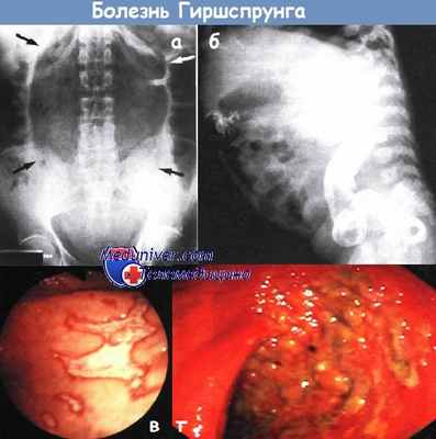 Болезнь Гиршспрунга