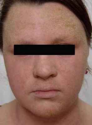 Атопический дерматит