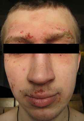 Атопический дерматит