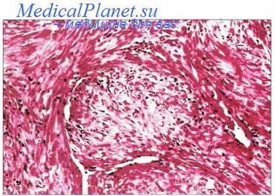 инфантильный миофиброматоз