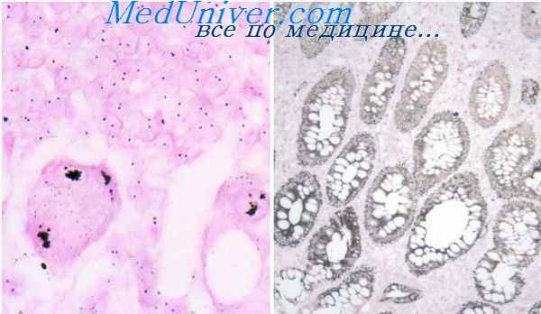 фиброматоз