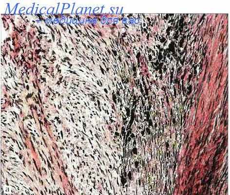 инфантильный миофиброматоз