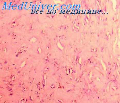 фиброматоз шеи