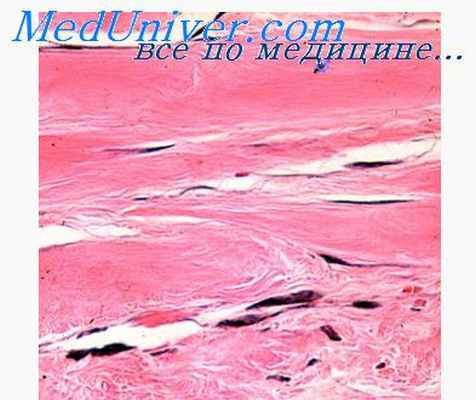 эластофиброма