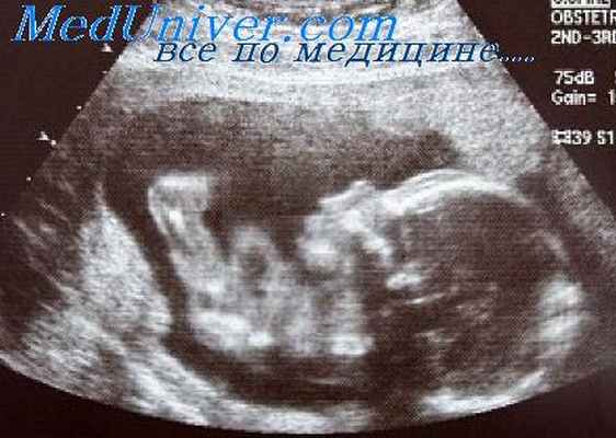 врожденный спид