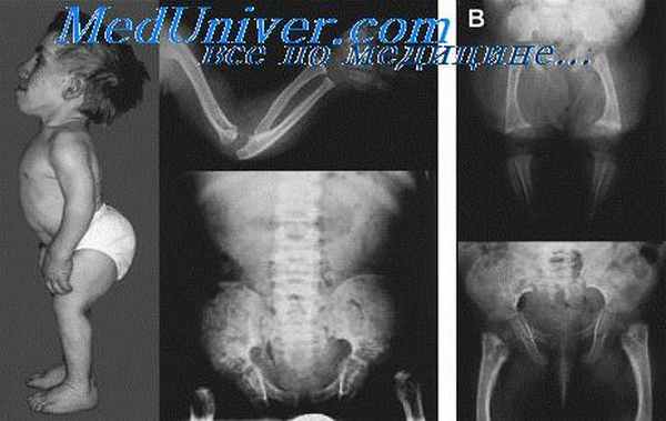 вывих лучевой кости