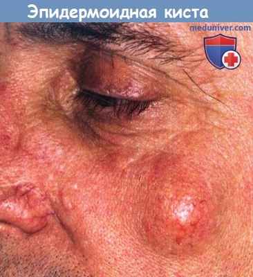 Эпидермоидная киста