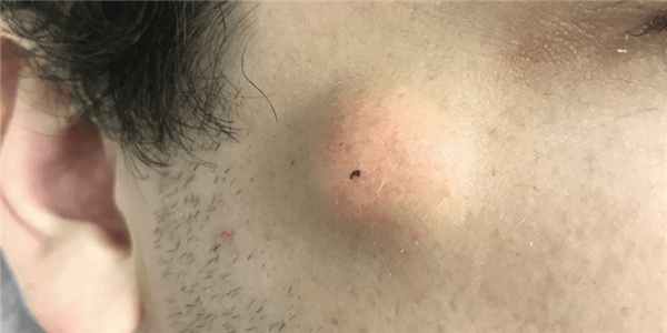 киста на лице