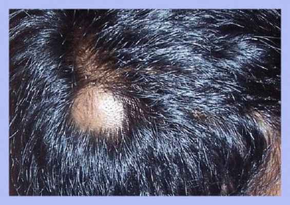 волосяная киста