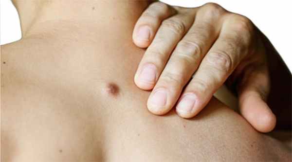 Эпидермальная киста