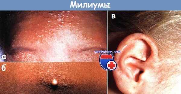 Милиумы у новорожденных детей