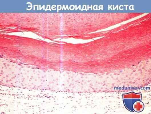 Гистология эпидермоидной кисты